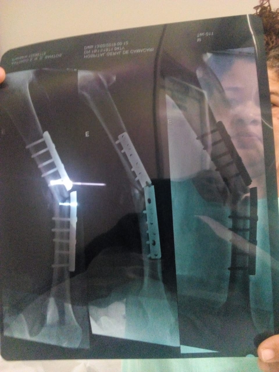 Sidney teve a placa rompida em sua perna dois meses depois de implantada - Foto cedida Sidney teve a placa rompida em sua perna dois meses depois de implantada - Foto cedida